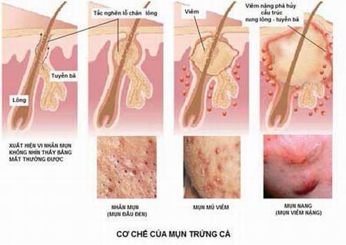 Dùng isotretinoin trị mụn trứng cá, những lưu ý cần biết - Ảnh 3.