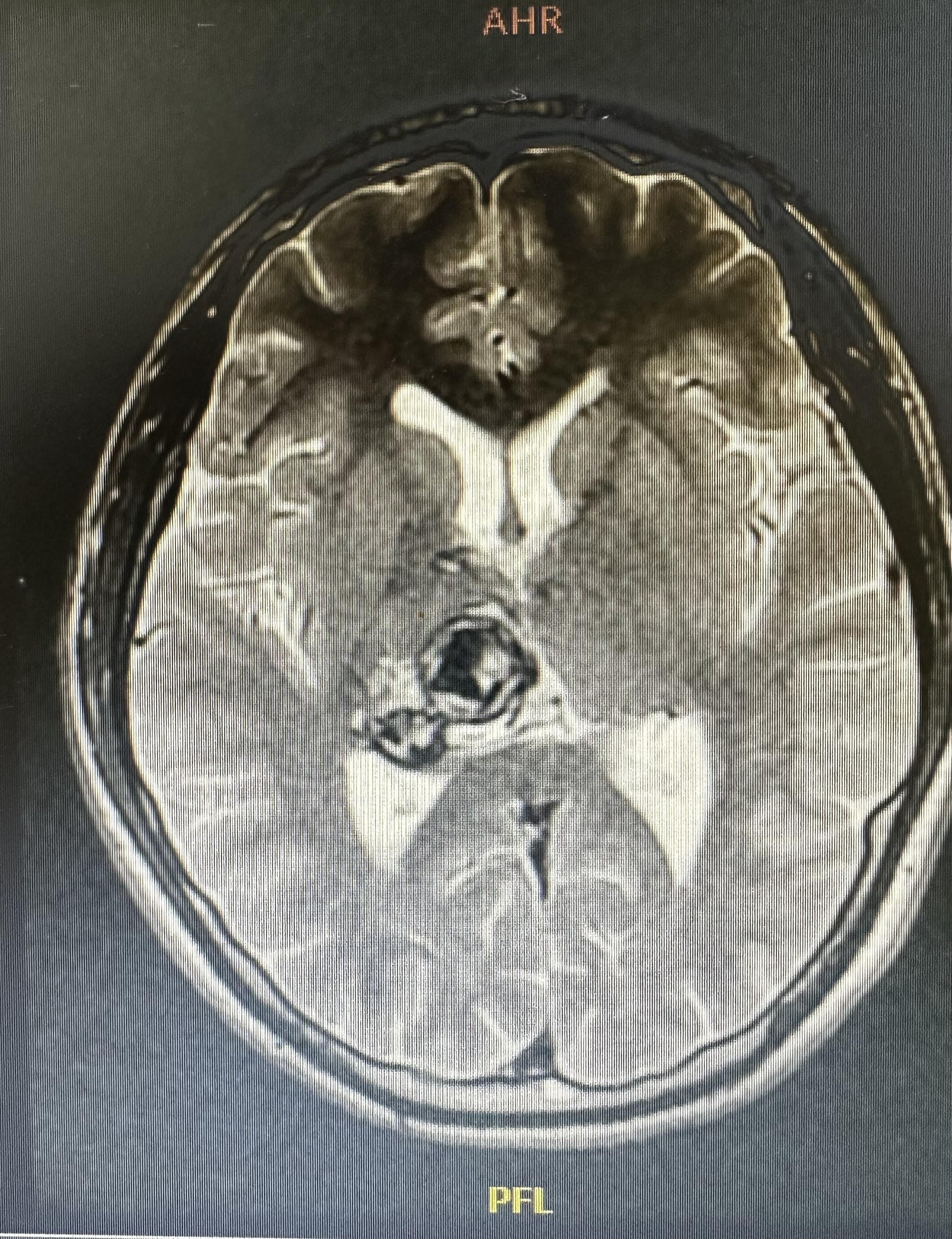 Đau đầu, chóng mặt, đi khám nam thanh niên phát hiện khối u máu tại não - Ảnh 1.