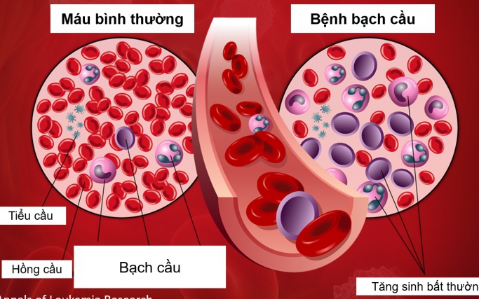 Hy hữu: Tình cờ phát hiện ung thư máu sau khi bị râu tôm chọc vào ngón tay