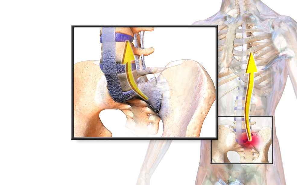 5 biện pháp giảm triệu chứng viêm cột sống dính khớp