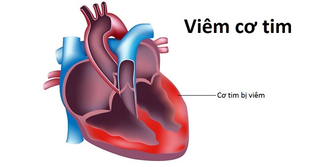 Tổng hợp thông tin về viêm cơ tim trẻ em