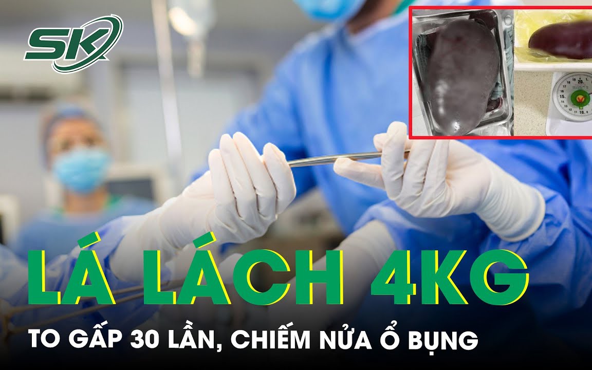 Mệt mỏi, vàng da, bác sĩ phát hiện bệnh nhân lá lách to gấp 30 lần, chiếm nửa ổ bụng