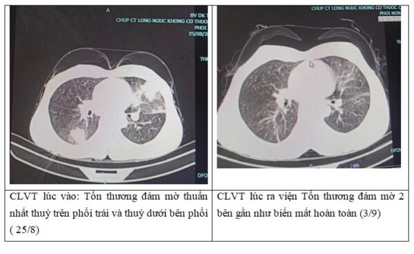 Phim chụp cắt lớp vi tính của người bệnh viêm phổi.