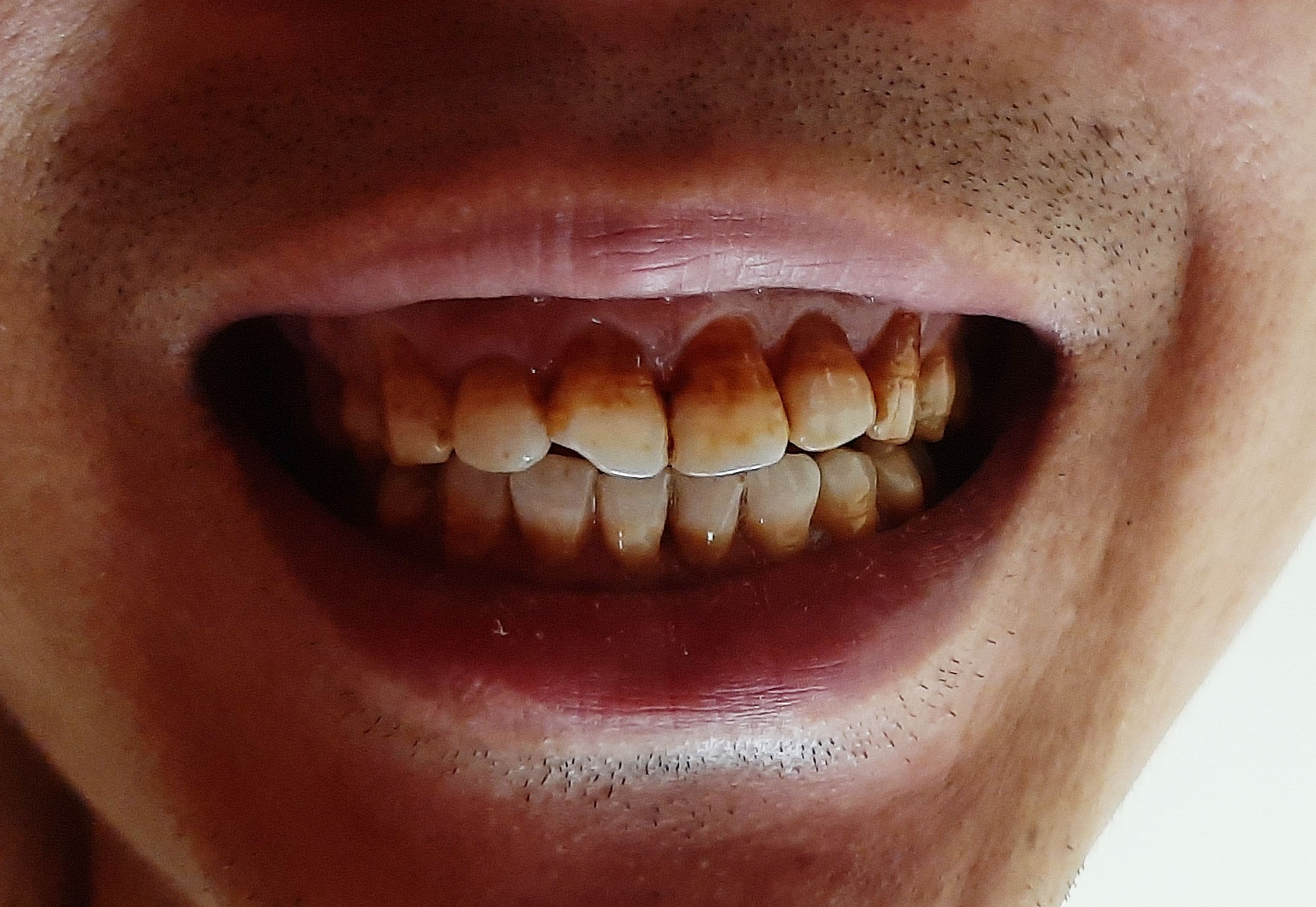 Hút thuốc khiến răng ố vàng, môi thâm mà còn gây ra các bệnh lý về răng miệng nhiều người chưa biết - Ảnh 1.