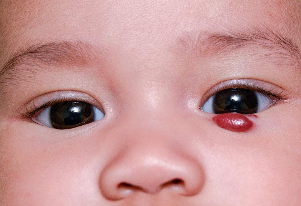 U máu vùng hàm mặt ở trẻ có cần điều trị? - Ảnh 2.