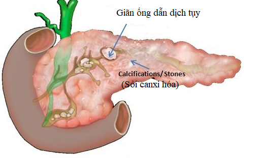 Đau bụng suốt 20 năm nhập viện phát hiện mắc sỏi tụy, cần cảnh giác với bệnh này - Ảnh 2.