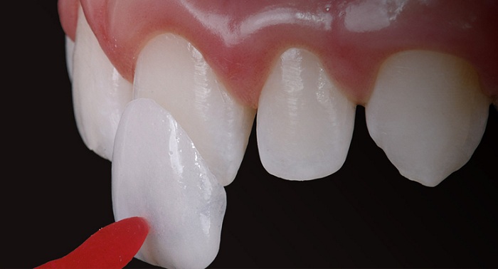 Vì sao dán răng sứ veneer có thể gây dị ứng? - Ảnh 1.