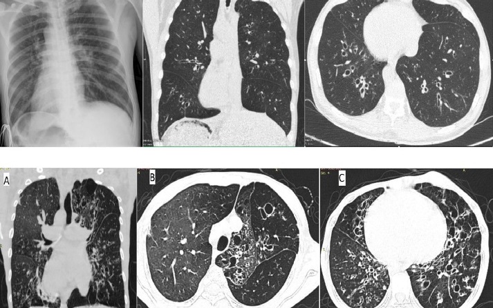 Mắc hội chứng Kartagener bệnh nhân thường bị viêm đường hô hấp và đảo ngược phủ tạng 