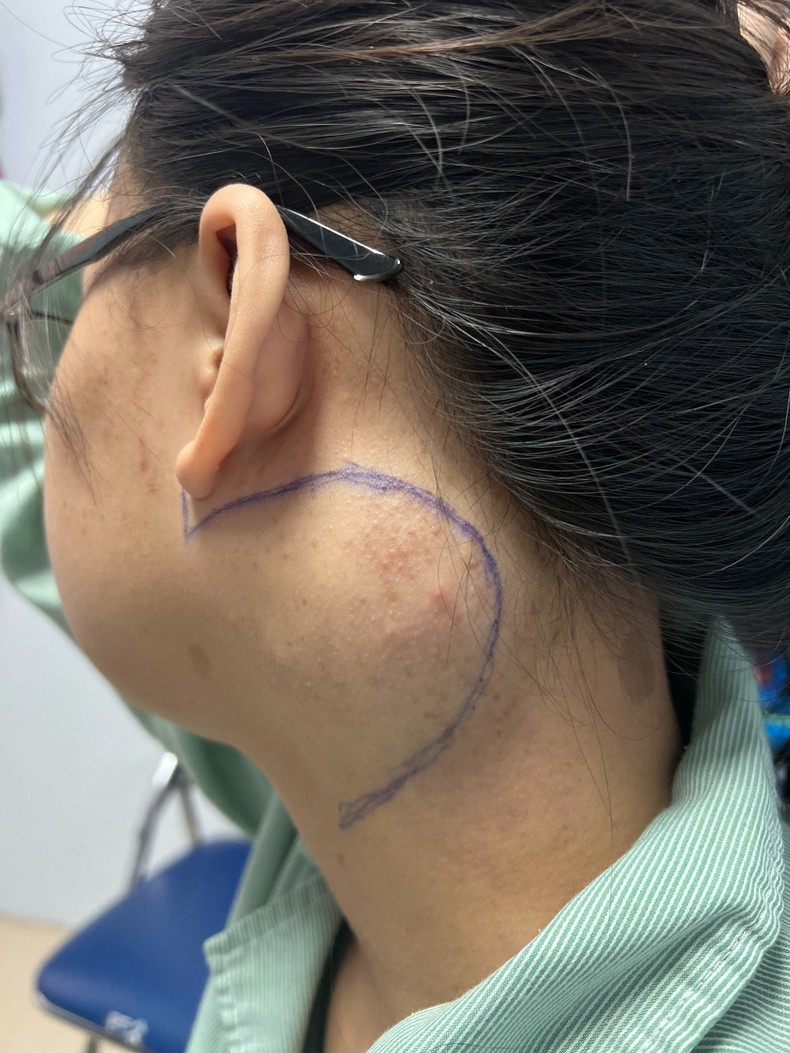 Thiếu nữ Hà Nội vỡ oà niềm vui vì được bác sĩ 'hoá giải' khối u thần kinh 'đeo' 7 năm ở vị trí cực kỳ nguy hiểm - Ảnh 1.