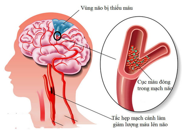 Thiếu máu lên não là tình trạng máu nuôi lên não không đủ, khiến tế bào não không được cung cấp đủ oxy và dưỡng chất cần thiết. Ảnh minh họa