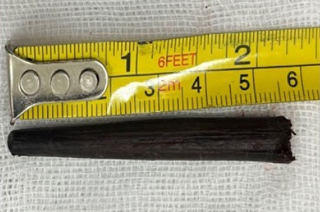 Hi hữu: Bị đũa gỗ dài gần 6cm đâm sâu vào hốc mắt- Ảnh 4.