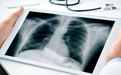 Làm nghề nào dễ mắc bệnh bụi phổi?