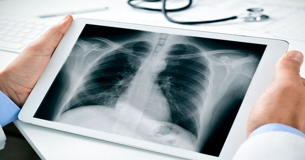 Bệnh phổi nghề nghiệp là bệnh phát sinh do hít phải bụi hoặc hóa chất độc hại trong quá trình lao động. Ảnh minh họa