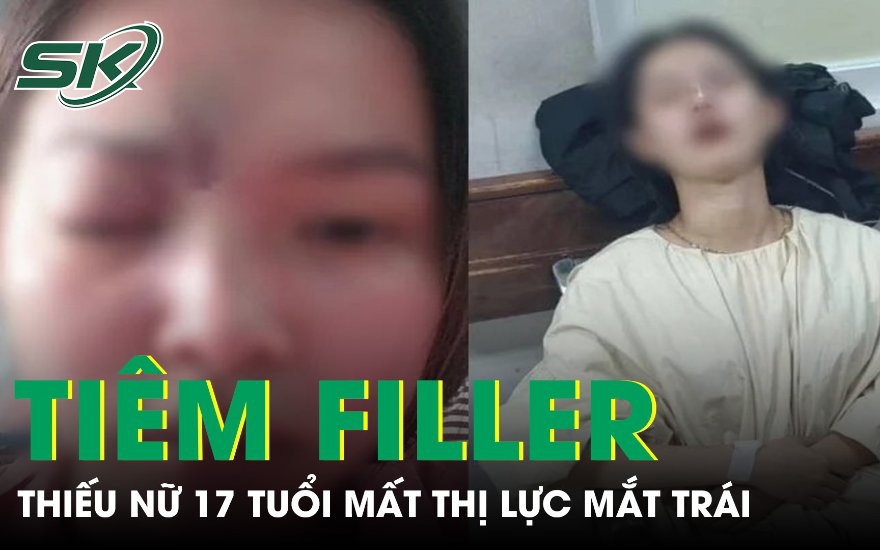 Tiêm filler tại spa, thiếu nữ 17 tuổi mất thị lực mắt trái