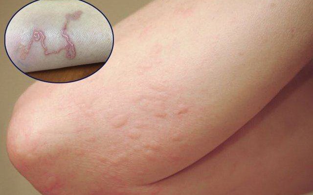 Nhiều người ở Khánh Hòa phải đi khám và điều trị bệnh sán chó- Ảnh 3. 7 dấu hiệu nhiễm sán chó ở người không thể bỏ qua