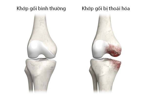 Thoái hóa khớp (còn gọi là hư khớp) là hậu quả của quá trình cơ học và sinh học gây tổn thương toàn bộ các thành phần của khớp. Ảnh minh họa