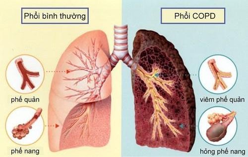 Ai dễ mắc bệnh phổi tắc nghẽn mạn tính?- Ảnh 1.