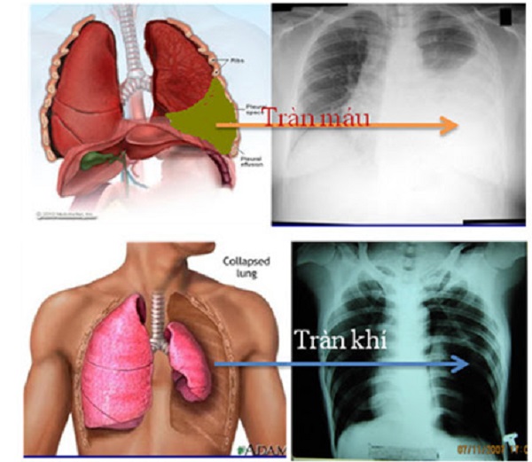 Tràn khí màng phổi ở những người hút thuốc lá- Ảnh 1.