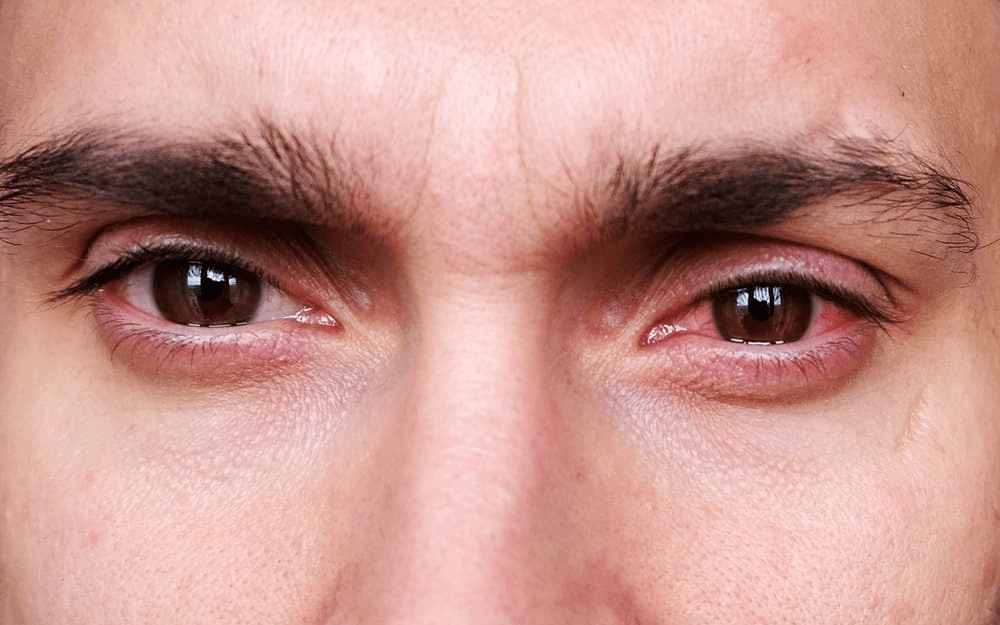 Làm gì khi mắc viêm kết mạc mùa xuân?- Ảnh 1. 3 biểu hiện của viêm kết mạc mùa xuân