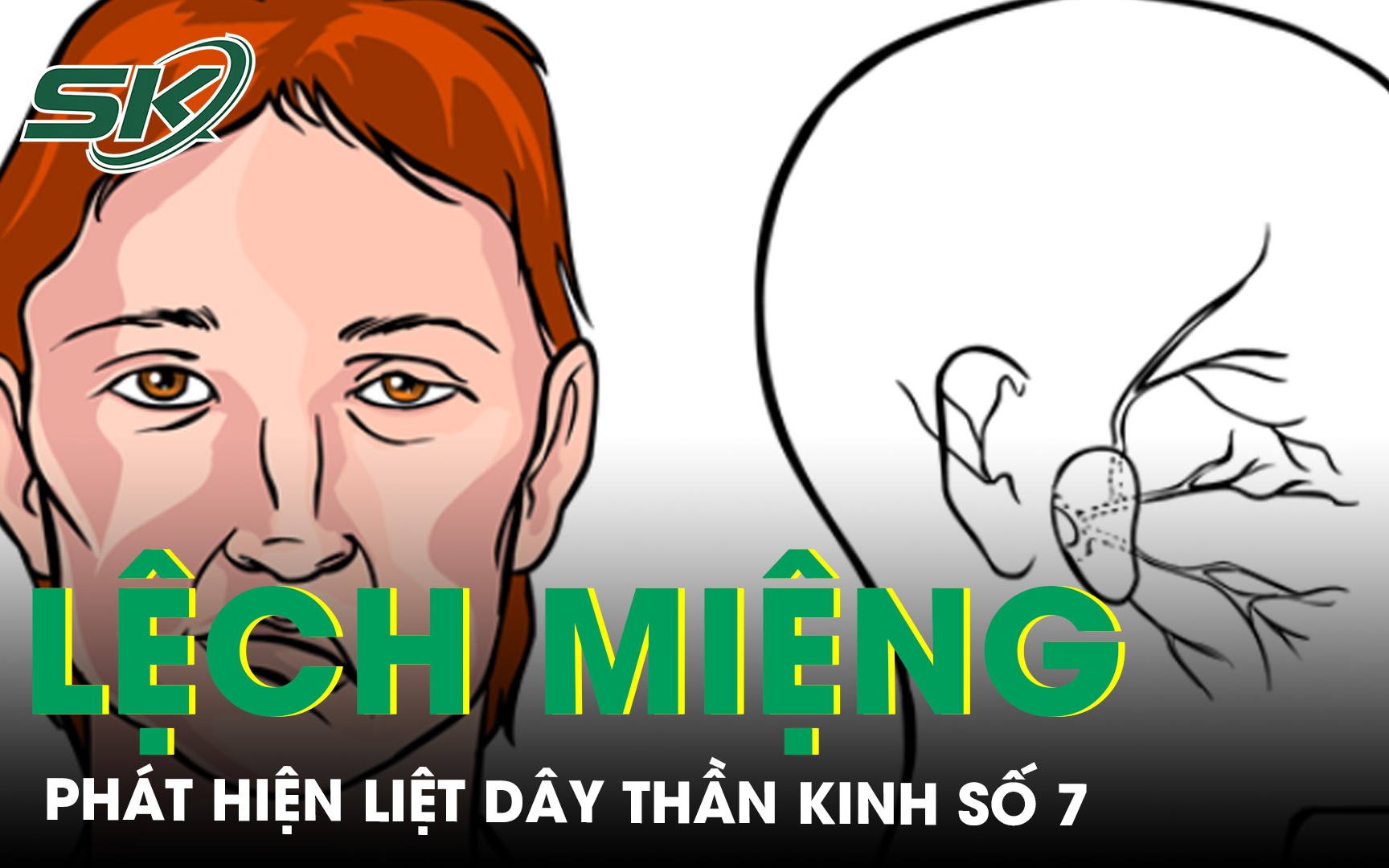 Bé gái đột ngột cười lệch miệng, không ngờ bị liệt dây thần kinh số 7