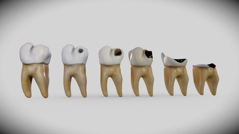 6 biểu hiện của sâu răng cần lưu ý- Ảnh 1.