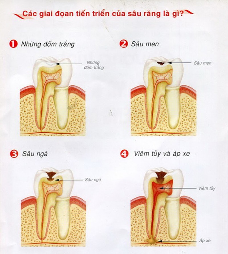 6 biểu hiện của sâu răng cần lưu ý- Ảnh 2.