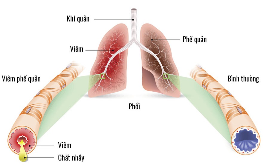 Những triệu chứng viêm phế quản cấp cần lưu ý