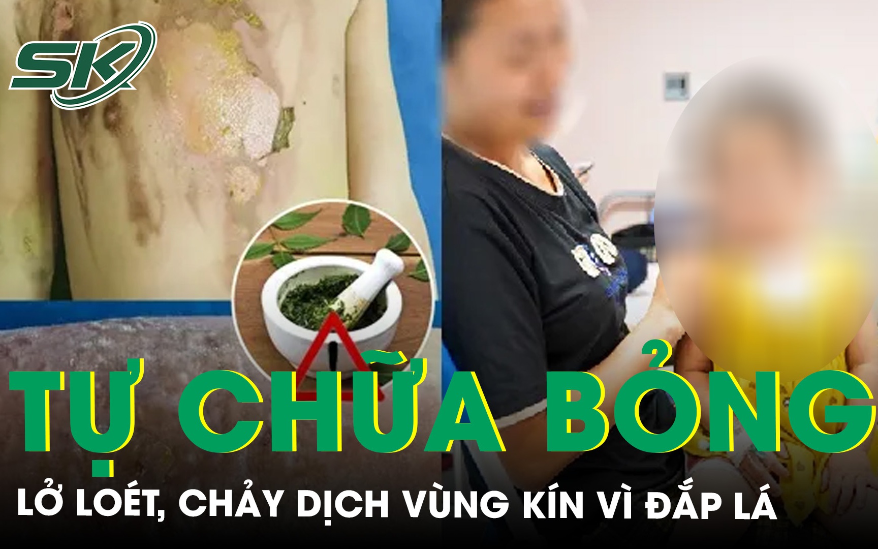 Bé 2 tuổi lở loét chảy dịch vùng kín vì bố mẹ tự đắp lá chữa bỏng tại nhà