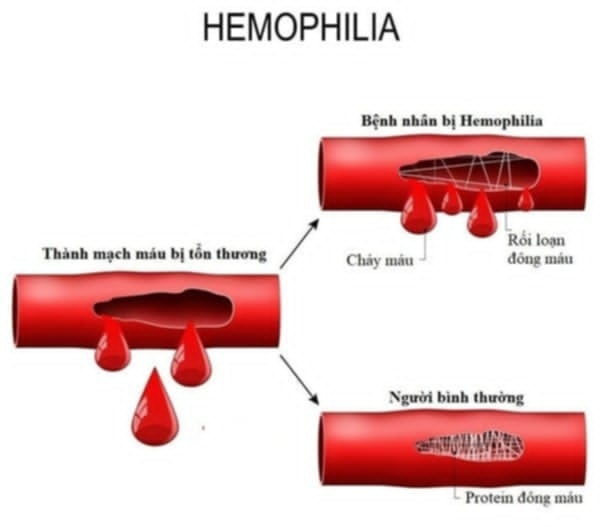 Máu khó đông: Nguyên nhân, triệu chứng, cách điều trị và phòng bệnh- Ảnh 1.