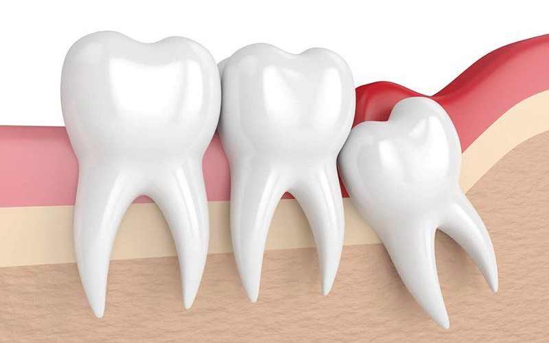 Nhổ răng khôn có nguy hiểm không, khi nào cần nhổ?- Ảnh 3.