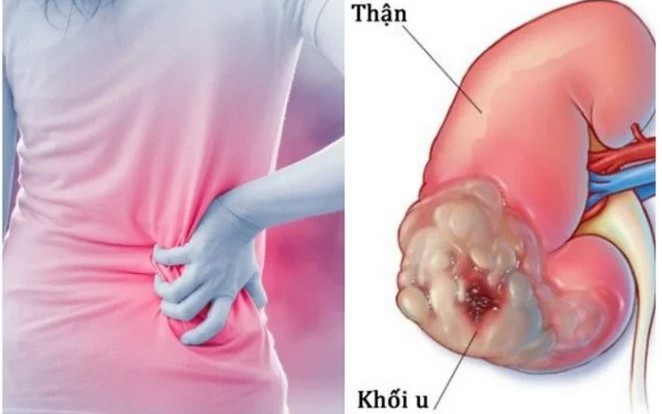 Sụt cân nhanh có phải ung thư thận?