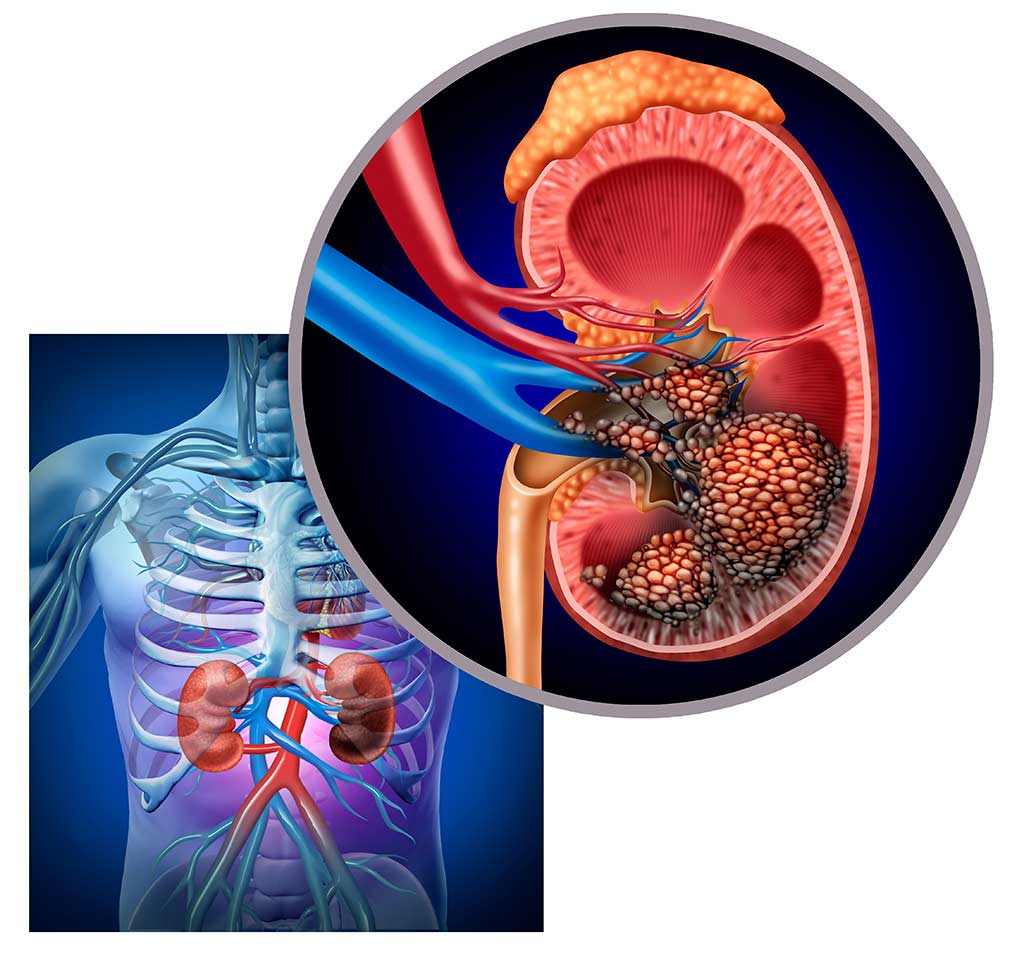 Sụt cân nhanh có phải ung thư thận?- Ảnh 1.