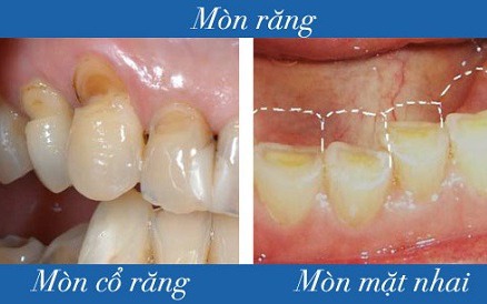 Mòn răng: Nguyên nhân, triệu chứng, cách điều trị và phòng bệnh