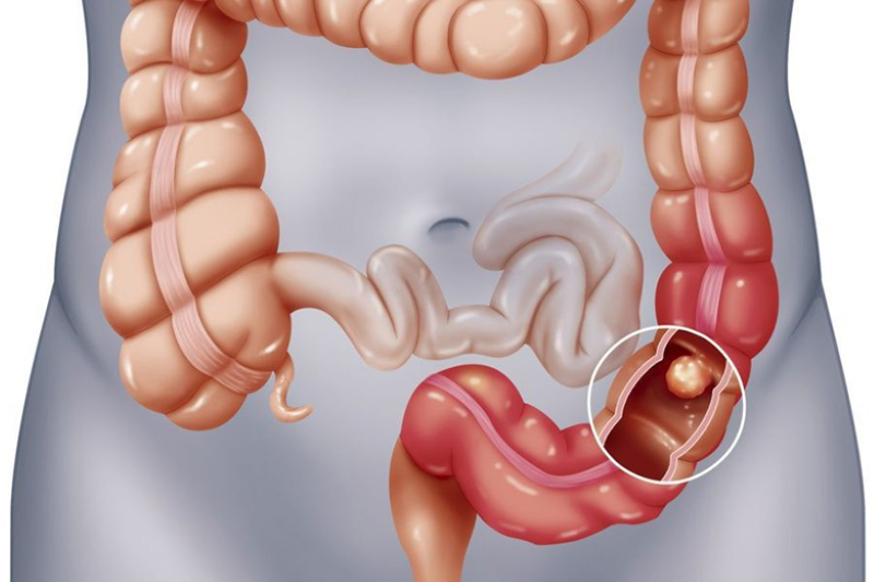 Polyp ống tiêu hóa: Nguyên nhân, triệu chứng, cách điều trị và phòng bệnh- Ảnh 1.