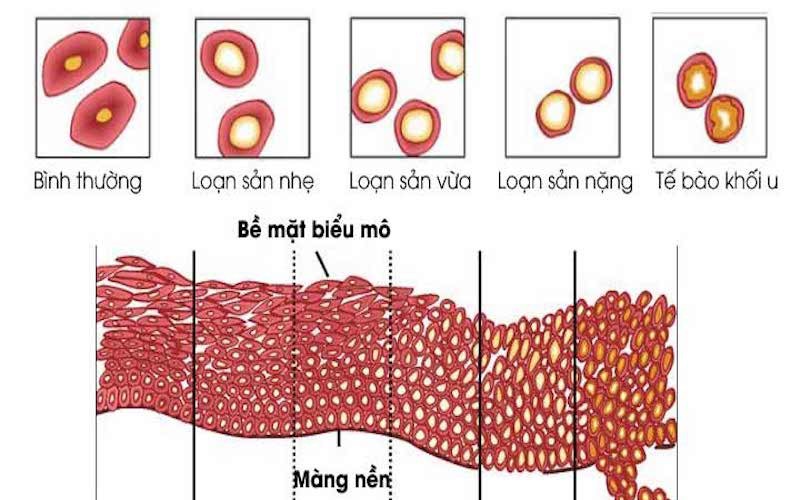 Loạn sản cổ tử cung: Nguyên nhân, triệu chứng, cách điều trị và phòng ngừa