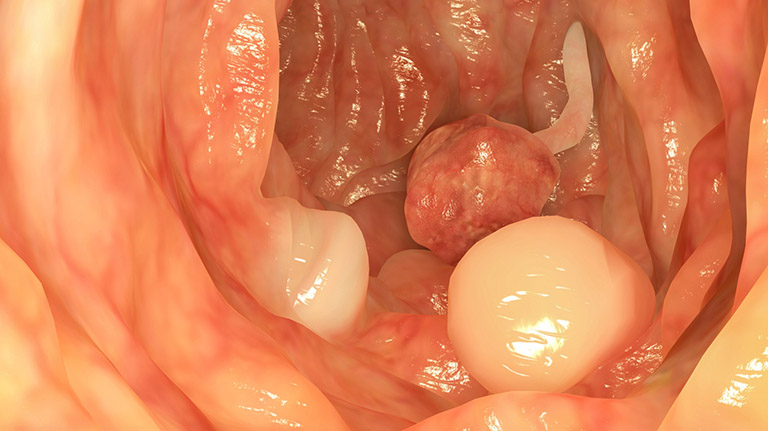 Polyp ống tiêu hóa: Nguyên nhân, triệu chứng, cách điều trị và phòng bệnh- Ảnh 3.