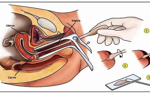 Thuốc và các phương pháp điều trị bệnh loạn sản cổ tử cung