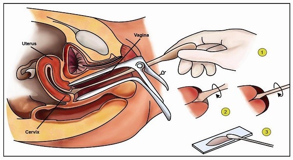 Thuốc và các phương pháp điều trị bệnh loạn sản cổ tử cung- Ảnh 2.