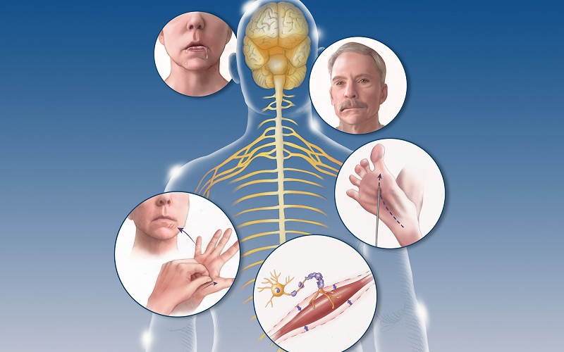 Bệnh xơ cột bên teo cơ: Nguyên nhân, triệu chứng, cách điều trị và phòng bệnh