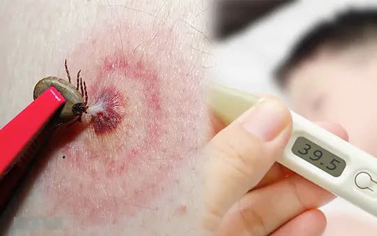 Babesia: Nguyên nhân, biểu hiện, cách điều trị và phòng bệnh