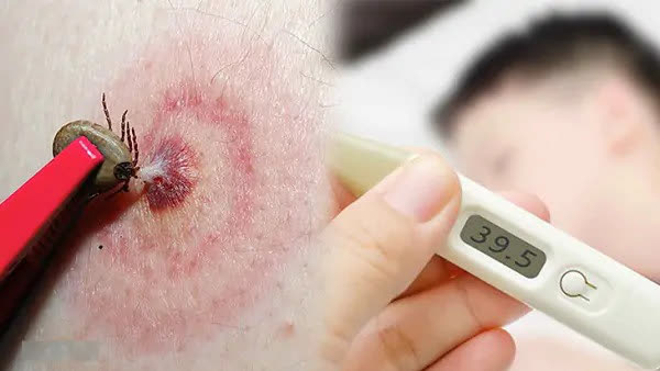 Babesia: Nguyên nhân, biểu hiện, cách điều trị và phòng bệnh- Ảnh 1.