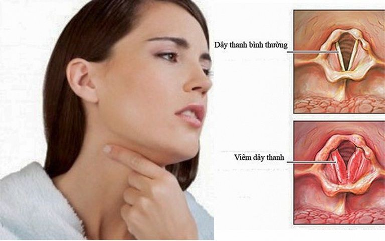 Viêm thanh quản cấp tính: Nguyên nhân, triệu chứng, phòng bệnh và cách điều trị