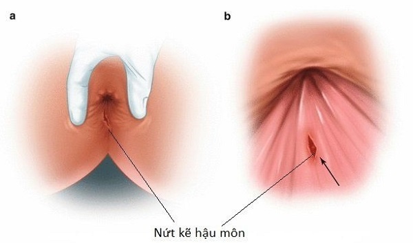 Bài tập hỗ trợ điều trị bệnh nứt kẽ hậu môn- Ảnh 1.