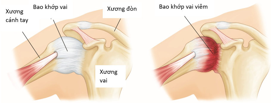 A diagram of the shoulder joint  Description automatically generated