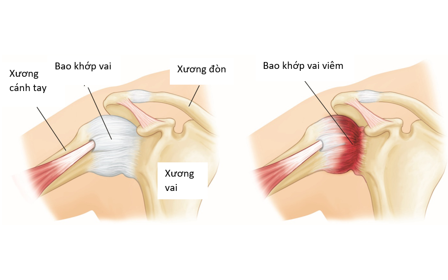 Viêm chóp xoay: Nguyên nhân, triệu chứng, cách điều trị và các biện pháp phòng ngừa