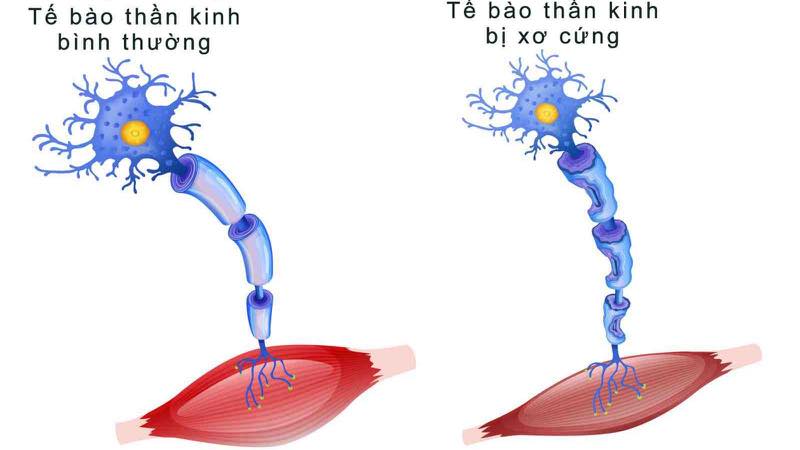 Thuốc điều trị bệnh xơ cột bên teo cơ- Ảnh 1.