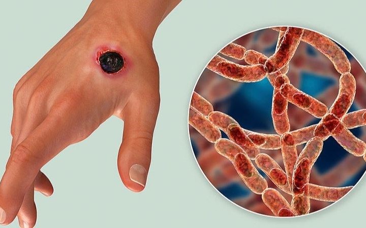 Vết thương hở và nguy cơ lây truyền HIV: Hiểu rõ để phòng ngừa hiệu quả- Ảnh 2.