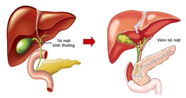 Hình ảnh viêm túi mật và biến chứng đau vùng hạ sườn phải do rượu bia