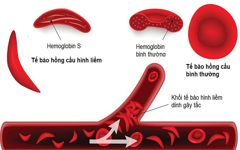 Bài tập tốt cho người mắc bệnh hồng cầu lưỡi liềm