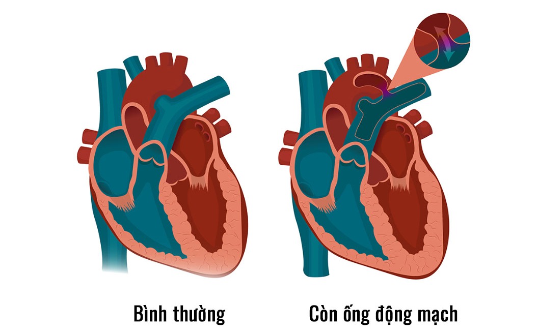 Còn ống động mạch: Nguyên nhân, triệu chứng, cách phòng ngừa và điều trị